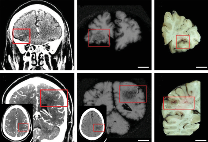 scans of brains with strokes